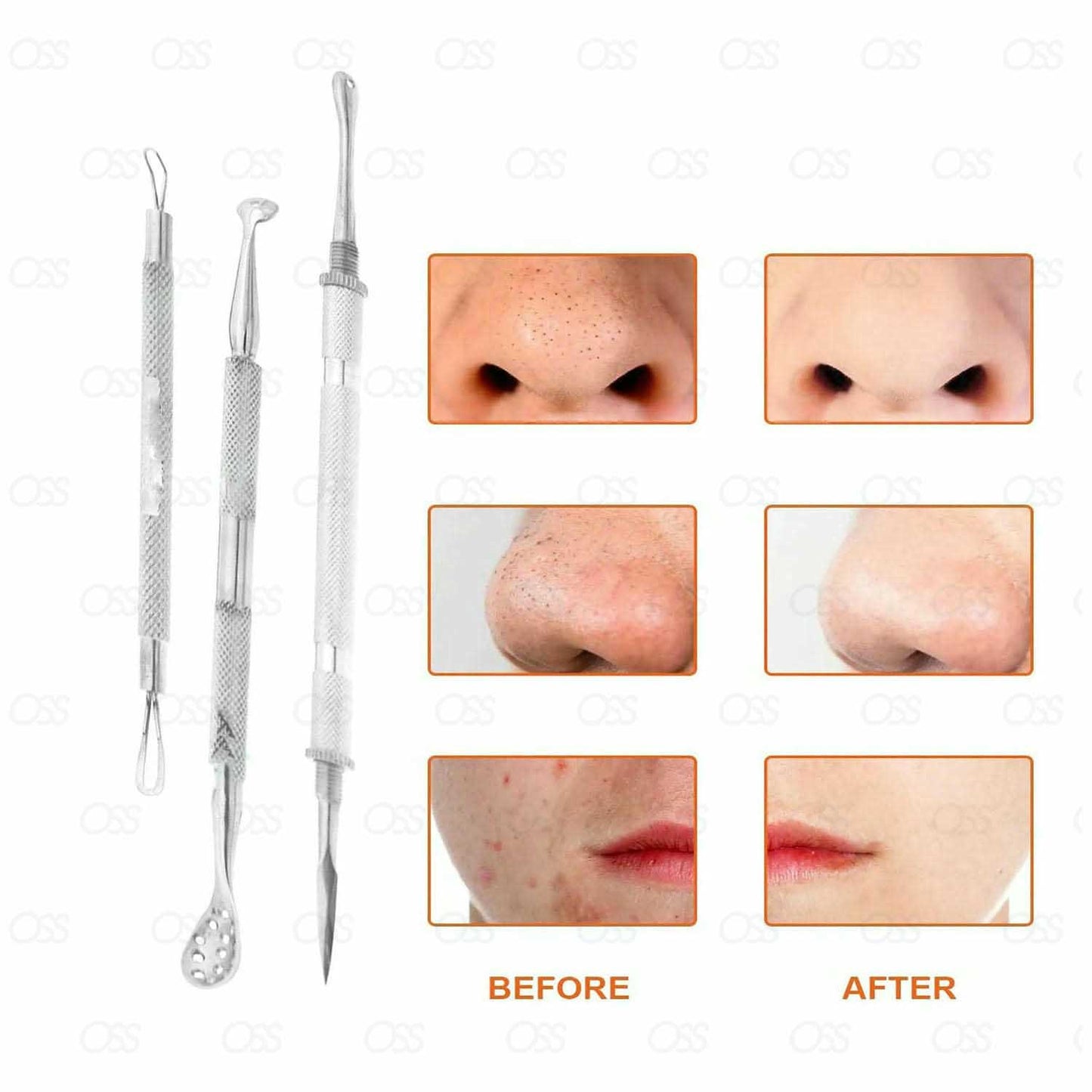 10pcs Blackhead Remover, Pimple Extractor, Ealicere Blackhead Extractor , Comedone Extractor Acne, Removal Kit, Whitehead, Blackhead