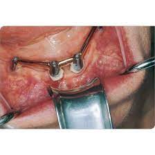 Minnesota Tongue Cheek Retractor Dental Instruments