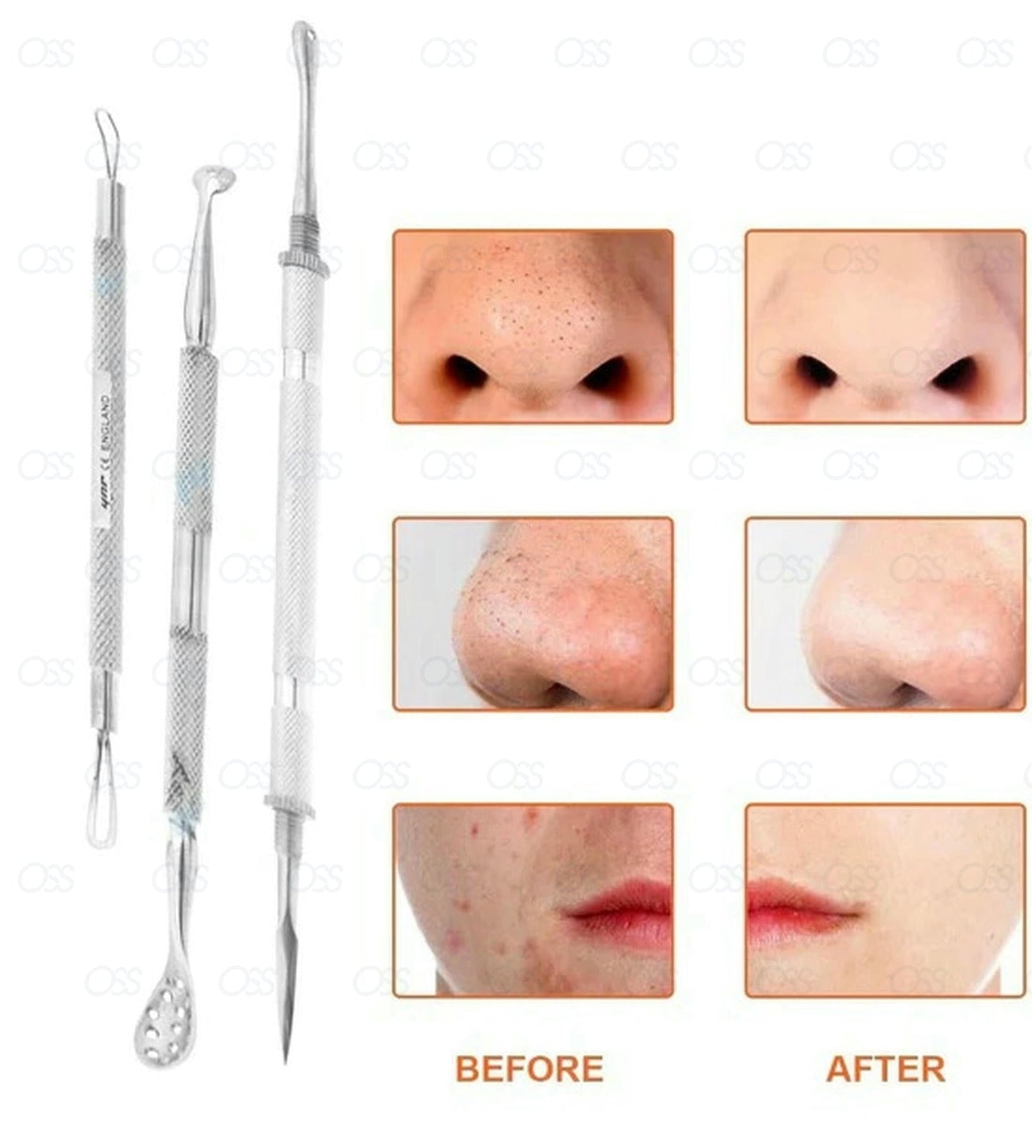 Blackhead Whitehead Pimple Acne Blemish Comedone Extractor Remover Tool Set