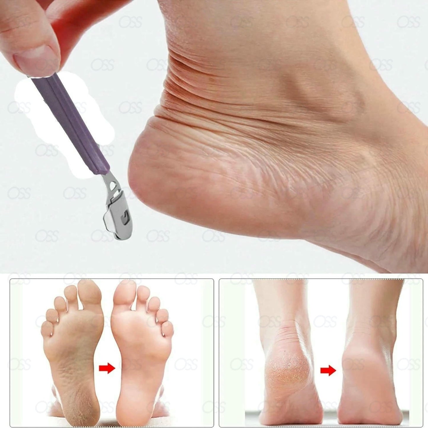 Callus remover Callus Corn Hard Skin Remover Shaver Foot Scraper Pedicure Kit