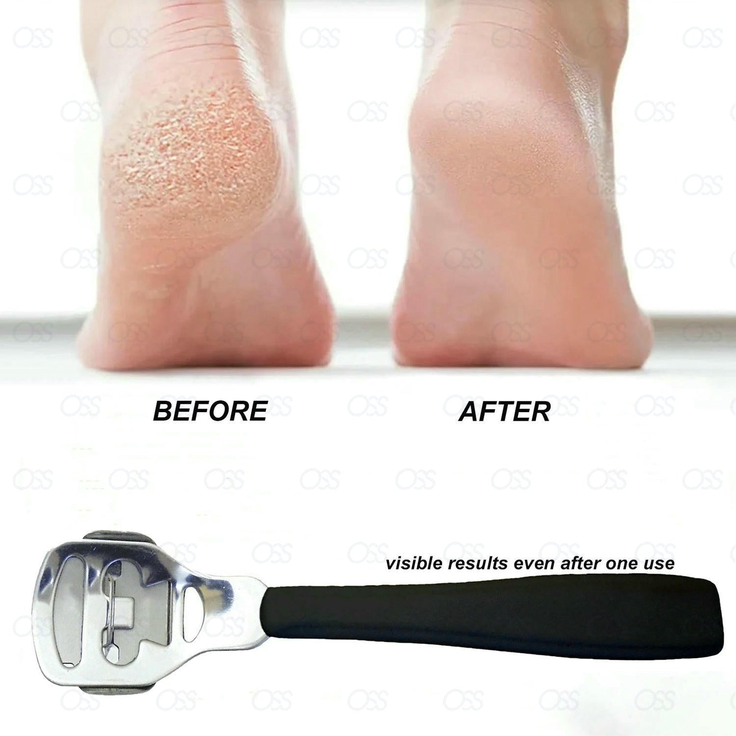 Callus Remover Corn Hard Skin Remover Shaver Foot Scraper Pedicure Kit