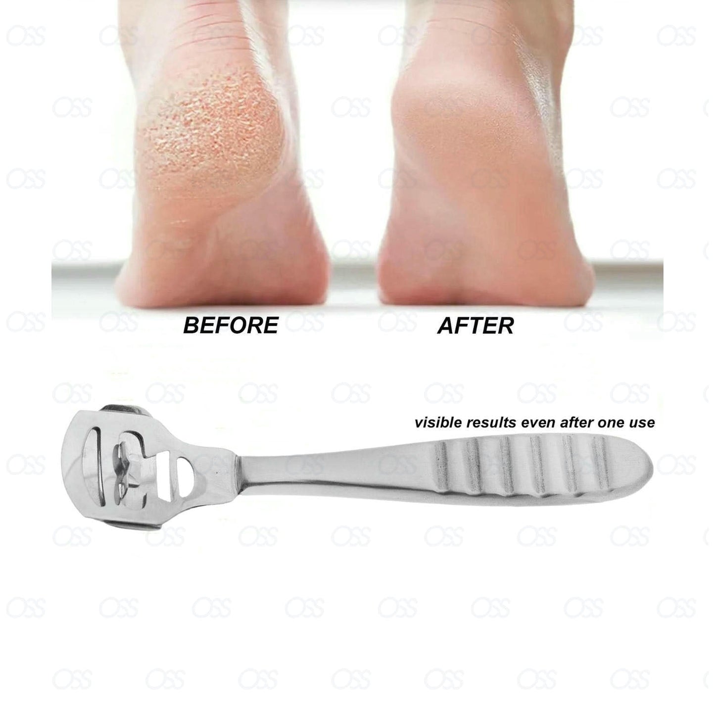 Corn and Callus Remover|Pedicure Tool for Safely Removing Corns|Calluses, Dead |Dry Hard Skin |Includes 10 Replacement Heads | Foot and Heel Scrubber Scraper, Corn Plane, Footcare