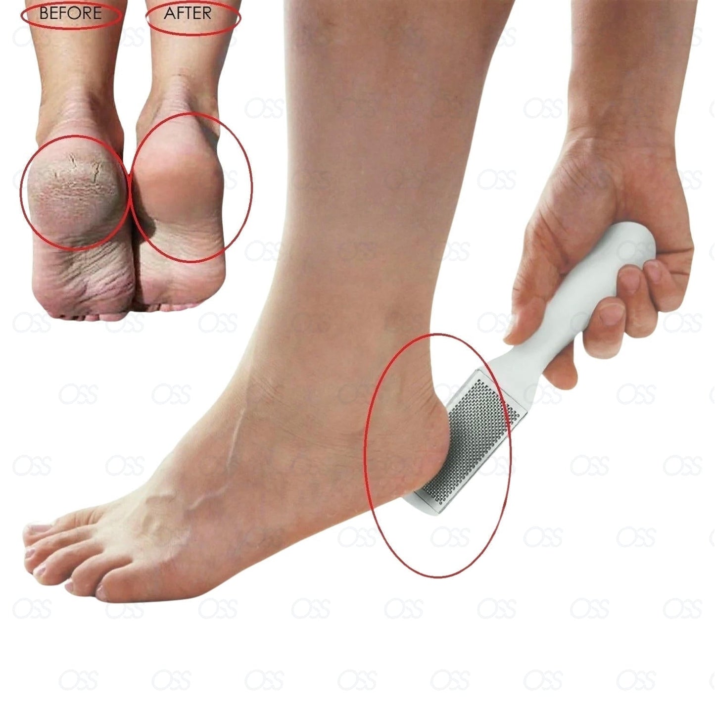 Callus Remover