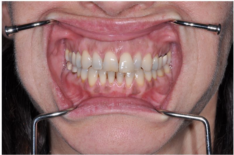 Dental Oringer Cheek Retractors with dental tools on a person's mouth