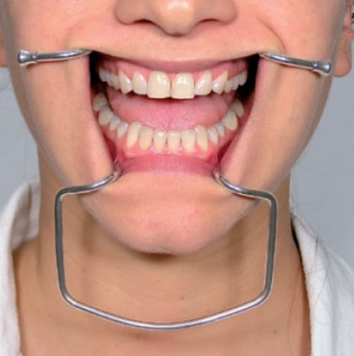 Person wearing a metal frame Oringer Cheek Retractors around their mouth and nose.