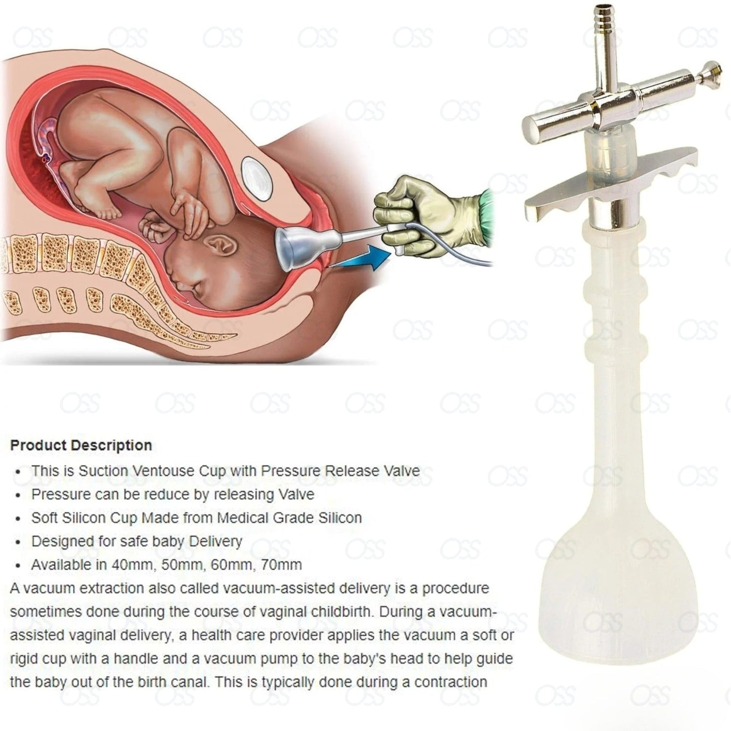 Silicone Vacuum Cup Ventouse Cup For Gynecology Vaccum Delivery